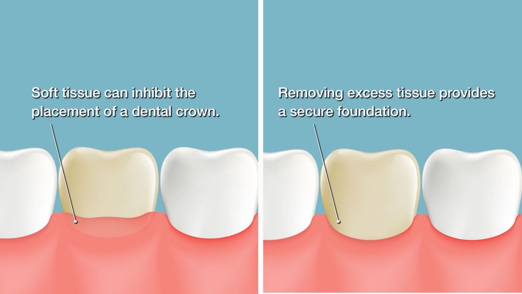 bleeding gums treatment